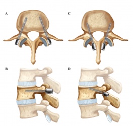 그림 2. 나사못 고정술의 두가지 형태. 좌:  척추경 나사못 고정술. 우: 피질골 나사못 고정술.